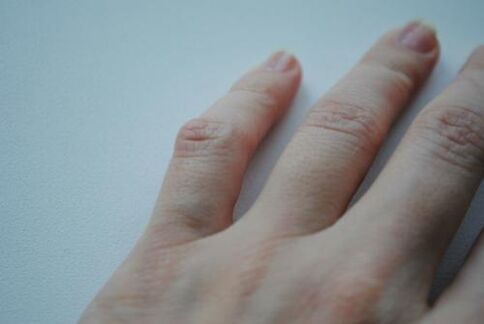 Um caroço artrítico apareceu no dedo mínimo. 