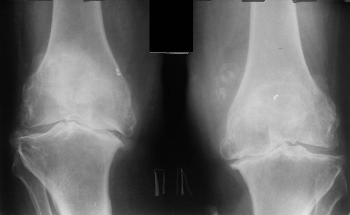 raio-x das articulações do joelho com artrose