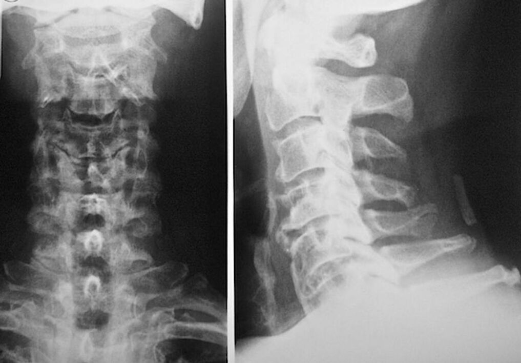 raio-x da coluna cervical com osteocondrose