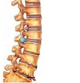 Como os osteocondrose da região cervical se desenvolve