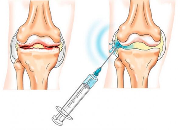 injeções intra-articulares para artrose do joelho