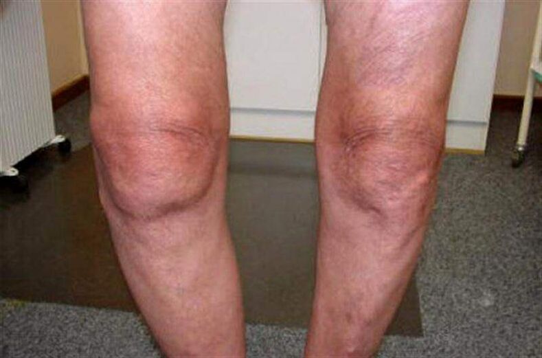 joelho inchado devido a artrite