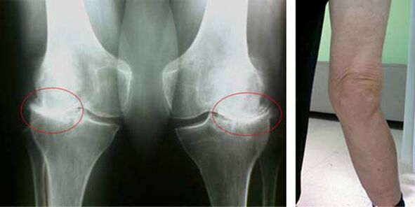 radiografia de osteoartrite do joelho