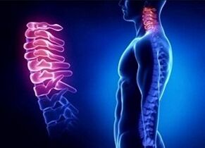 As razões para o desenvolvimento da osteocondrose cervical