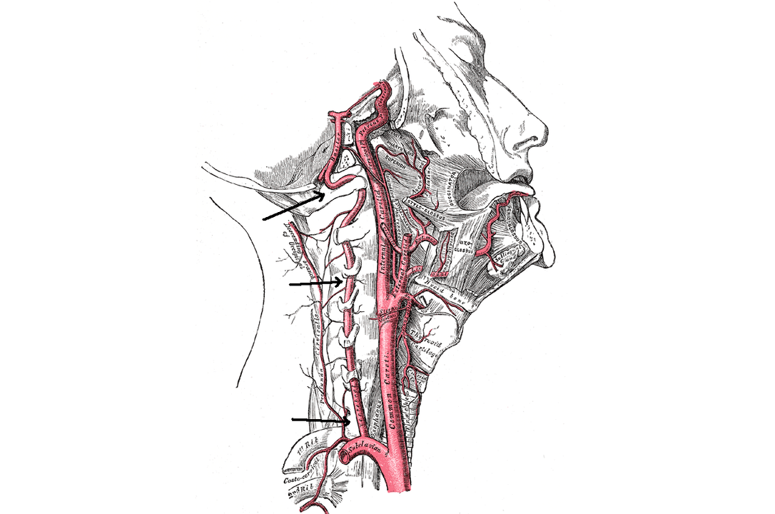 compressão da artéria vertebral com osteocondrose cervical