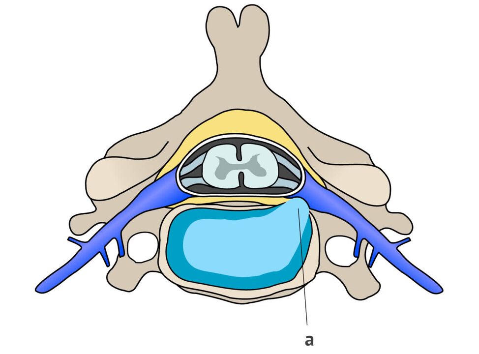 hérnia intervertebral com osteocondrose cervical