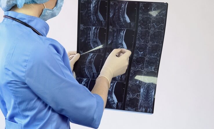 O diagnóstico de osteocondrose cervical é feito com base em um estudo de ressonância magnética