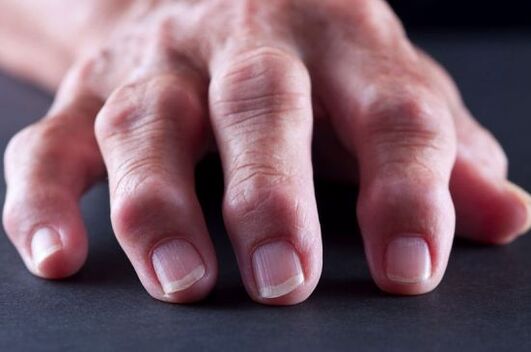 Deformidades articulares dos dedos devido a artrose ou artrite